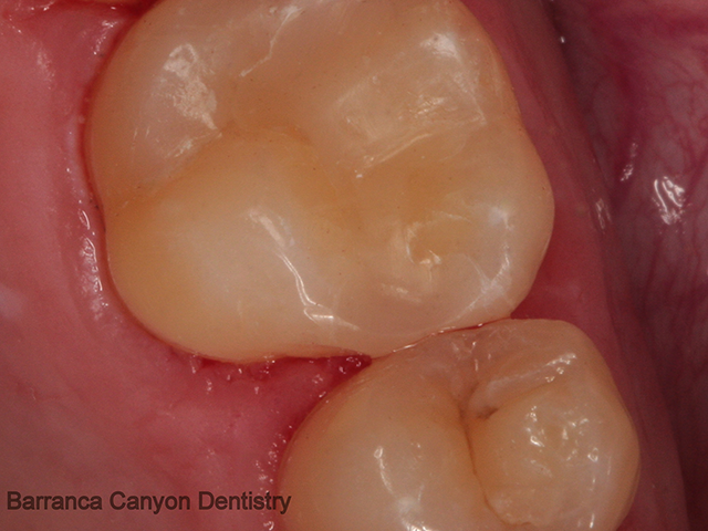 White Composite Fillings