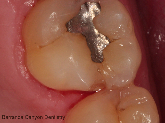 White Composite Fillings